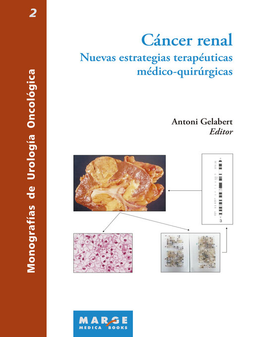 Title details for Cáncer renal by Antoni Gelabert Mas - Available